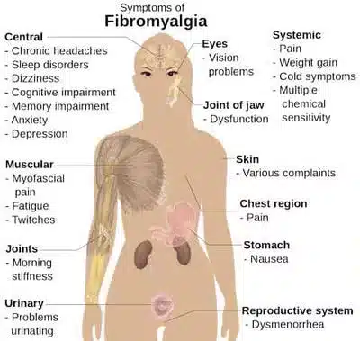 fibromyalgia-symptoms
